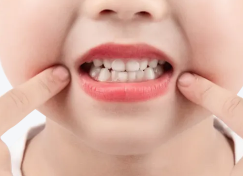 涂氟后多久能刷牙？河北惟德口腔醫(yī)生專業(yè)答疑