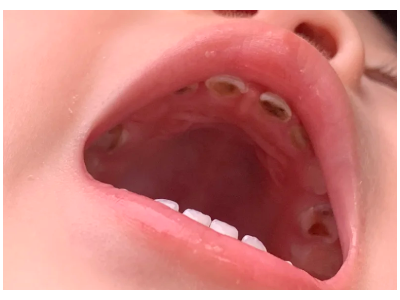 河北惟德口腔涂氟流程簡(jiǎn)單，孩子配合度拉滿