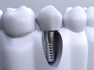 承德種植牙價格表，2024種植牙多少錢一顆呢?