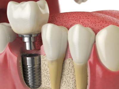 選擇種植牙后要做哪些日常維護？