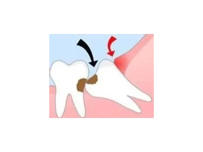 吃完飯后老塞牙？別大意！這可能是你的牙齒在報(bào)警