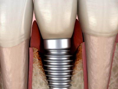 種植牙的術(shù)前準(zhǔn)備有哪些？