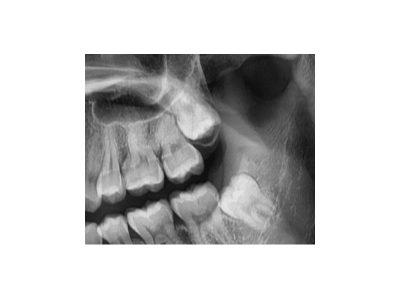 既然「智齒」不宜久留，為什么不能一次性拔掉？