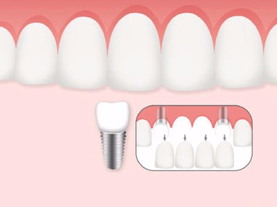 惟德口腔口腔種植怎么樣？惟德口腔就來為您一一解答