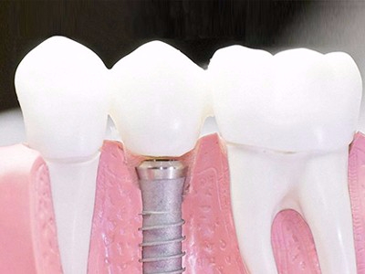 在承德口腔種植齒需要多少錢？惟德口腔一一為您道來