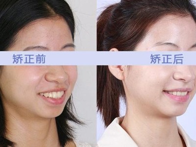 牙齒矯正與正畸的區(qū)別及治療護(hù)理要點